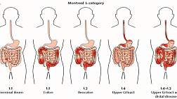 Монреальская классификация болезни Крона